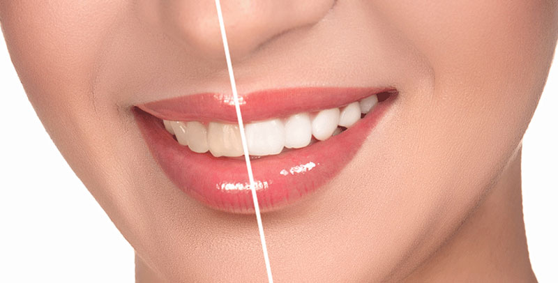 Faccette Dentali