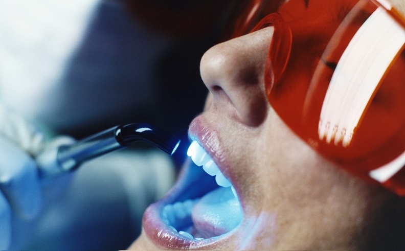 come funziona lo sbiancamento dentale