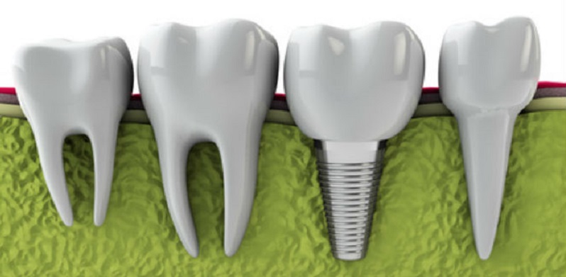 implantologia dentale roma 2